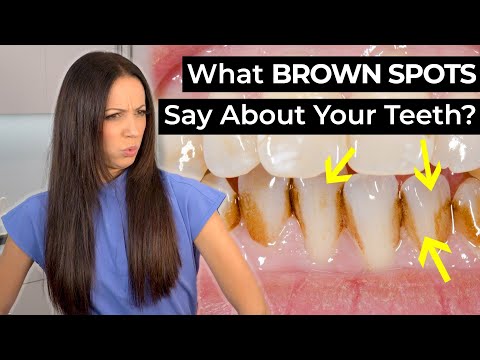 What Do BROWN SPOTS on Your Teeth Mean?