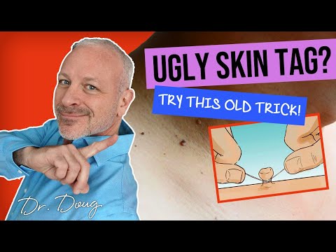 GET RID OF UGLY SKIN TAG! ðŸ”´ Tie with a STRING!